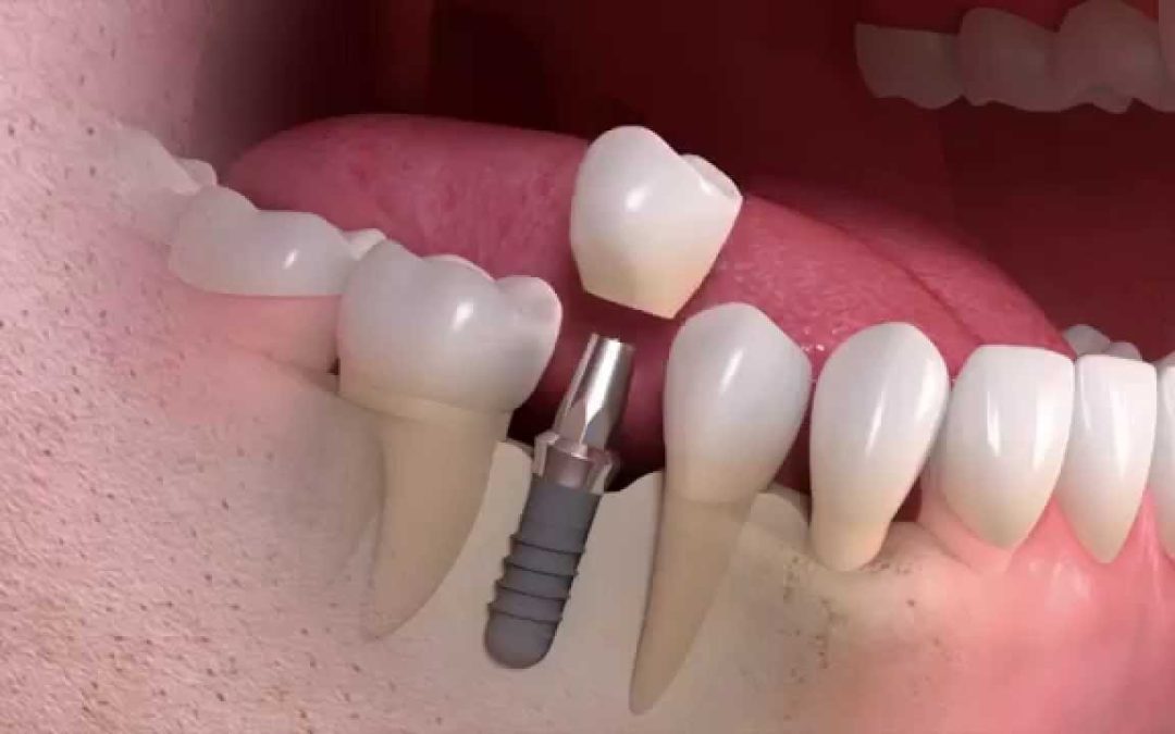 Implantes dentários são para a vida?